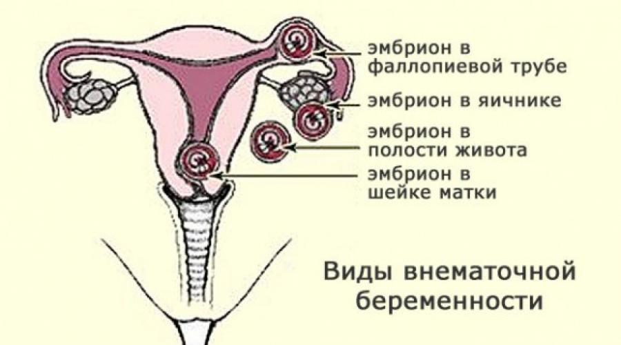 Где находится матка при беременности на ранних сроках фото